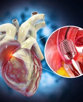 Balloon angioplasty procedure with stent in vein.3d illustration